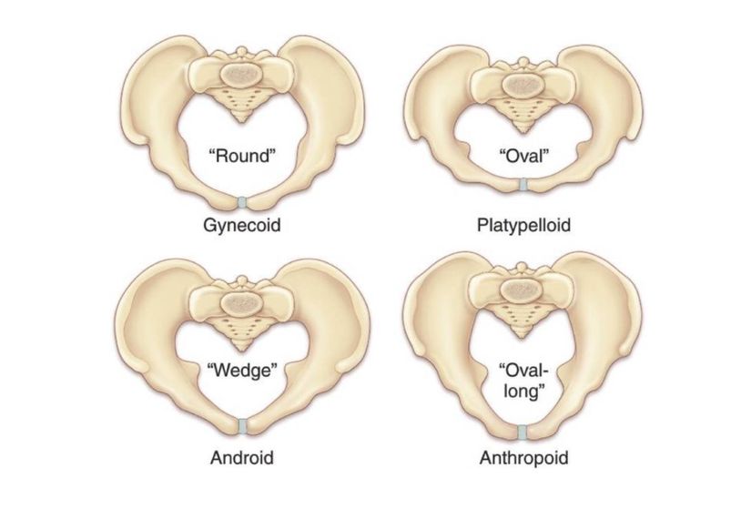 İnsan dişilerindeki pelvis çeşitliliği. Android tip ve platypelloid tip normal doğum yapamaz.