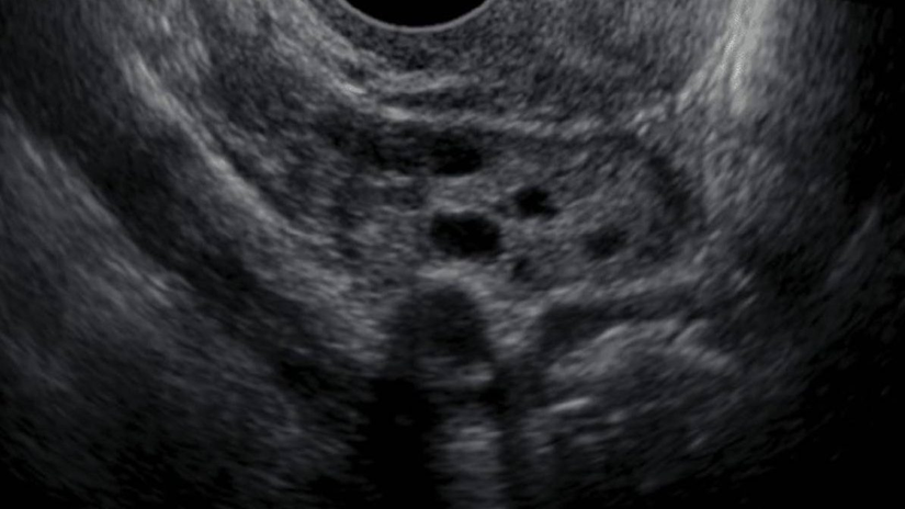 2D ultrason görüntüsündeki siyah yuvarlakların her biri bir foliküldür. Bunların bir tanesinin içerdiği yumurta, mevcut döngüde olgunlaşarak ovule olacaktır.