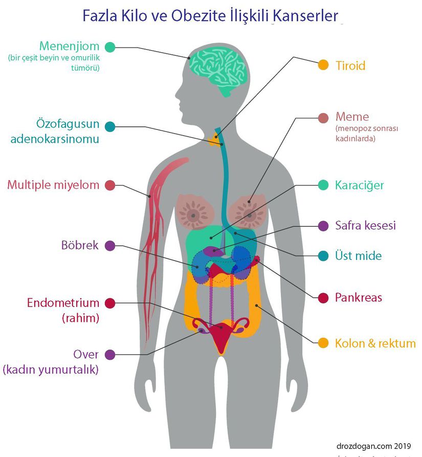 Obezite ile bağlantılı kanser türleri