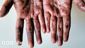 Jammu And Kashmir Takes Action Against Monkeypox Emergency