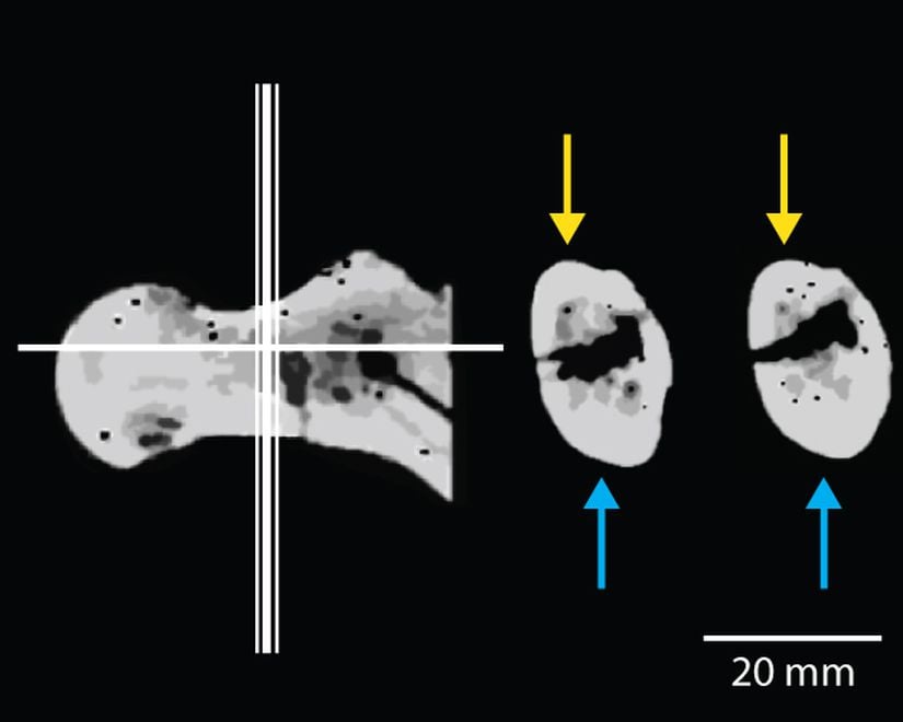 Şekil 3: Orrorin tugenensis’e ait örneklerden BAR 1002’00’ın femoral boynunun CT taraması. Görüntünün sağındaki figürde femoral boyundan alınan enine kesit gösteriliyor. Femoral boyundaki kortikal kemiklerin dağılımı asimetrik; korteksin alt kısmı (mavi ile gösterilen) üst kısmından (sarı ile gösterilen) daha kalın. Modern insanlar kortikal kemikte benzer asimetrik dağılıma sahipken Afrika primatları daha fazla dağılıma sahiptir. Bunun nedeni iki ayaklılık ile dört ayaklılığın farklı morfolojik özellikleri tetikliyor olmasıdır.
