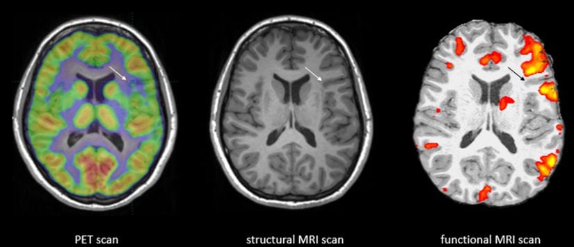 Fonksiyonel Manyetik Rezonans Görüntüleme (fMRI)