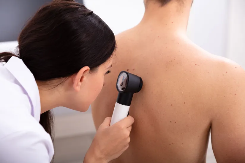 Dermatoskopi deri yüzeyi mikroskopisidir, benlerin ve diğer pigmentli lezyonların tanısında kullanılır.