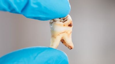 Diş Çürüğü Bulaşıcı Bir Hastalık Mıdır?