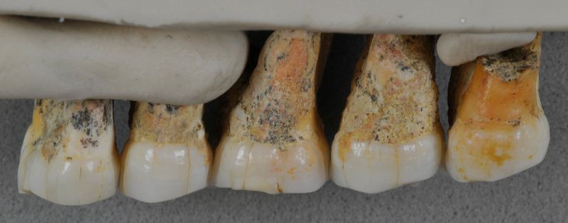 Çıkarılan diş fosilleri