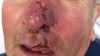 Ekstranodal NK/T Hücreli Lenfoma, Nasal Tip (ENKL) Nedir? Burun ve Yüzün Orta Hattını "Çürüten" Kötü Huylu Kitleler Tedavi Edilebilir mi?