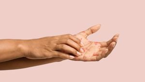 New Cream Offers Hope For Chronic Hand Eczema