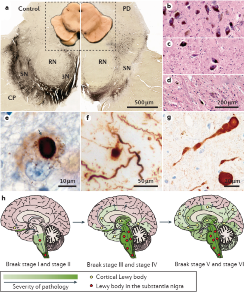 | Parkinson hastalığı için ana tanısal nöropatolojiler. a | Parkinson hastalığı (PD), kontrole (sol panel) kıyasla substantia nigra (SN) (sağ panel) depigmentasyonu ile tanımlanır. Dopamin sentezi için hız sınırlayıcı enzim olan tirozin hidroksilaz için immünohistokimyasal boyamanın ardından orta beynin makroskopik (iç) ve enine kesitleri gösterilmiştir. Daha medial ve dorsal bölgelerin korunması ile SN'nin ventrolateral kısımlarının seçici kaybı, histolojik bölümde belirgindir. b d | SN'nin ventrolateral bölgesinin hematoksilen ve eozin boyaması, sağlıklı bir kontrolde (bölüm b) normal bir pigmentli nöron dağılımı ve PD'de tanısal olarak önemli (bölüm c) veya şiddetli (bölüm d) pigmente hücre kaybı gösterir. e – g | Α ‑ sinükleinin immünohistokimyasal boyaması, yuvarlak, intrasitoplazmik Lewy cisimcikleri (bölüm e'deki ok), daha yaygın, granüler α ‑ sinüklein birikintilerini (kısım e ve kısım f), nöronal hücre süreçlerinde birikintileri (kısım f), hücre dışı nokta- aksonlardaki α ‑ sinüklein yapıları (kısım f) ve α ‑ sinüklein sferoidleri (kısım g) gibi. h | Alzheimer patolojisi olmadan PD'de α ‑ sinüklein agregasyonunun teorik ilerlemesi. α ‑ Sinüklein kapanımları, asemptomatik vakalarda kolinerjik ve monoaminerjik alt beyin sapı nöronlarında meydana gelir (Braak evre I ve evre II), PD'nin motor semptomları olanlarda (Braak evre III ve evre IV) orta beyindeki ve bazal ön beyindeki benzer nöronlara sızar, ve daha sonra hastalığın ilerlemesi olan limbik ve neokortikal beyin bölgelerinde bulunur (Braak evre V ve evre VI)