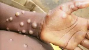 ECDC Raises Mpox Risk As New Strain Emerges