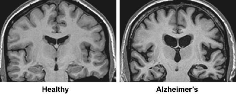 Sağlıklı bir beyin ve Alzheimer hastalığı olan bir beynin MRI karlılaştırması