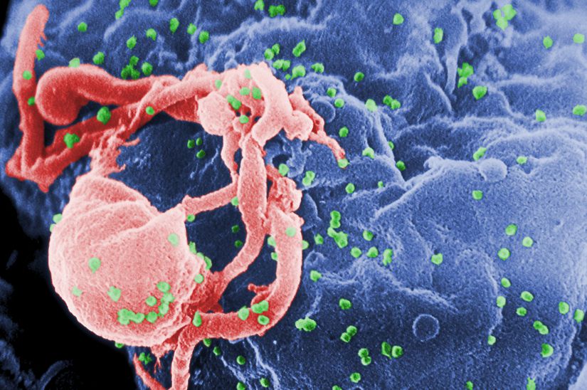 Taramalı elektron mikroskobu altında lenfositlerin (pembe) üzerindeki HIV-1 (yeşil) tutulumunu görüyorsunuz.