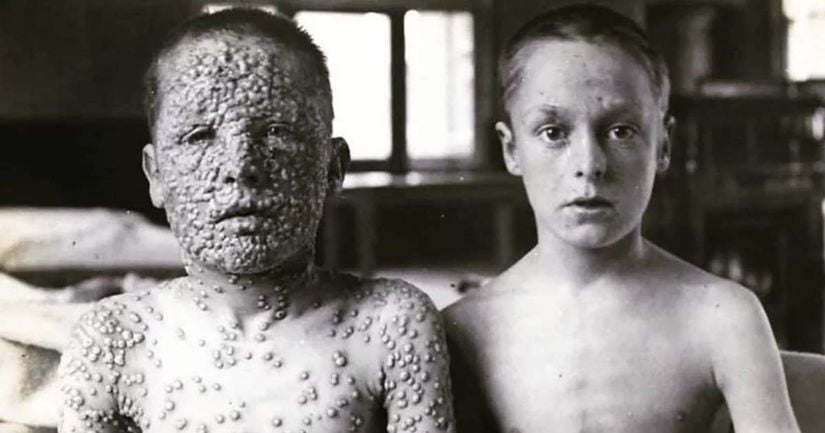 Sol tarafta çiçek hastalığı aşısı olmamış bir çocuk. Sağ tarafta ise aşıyı olmuş bir çocuk.