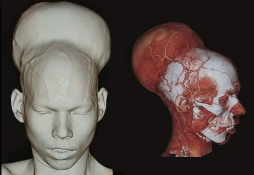 Üç Boyutlu Bilgisayarlı Tomografik Anjiyografi (3D-CTA)