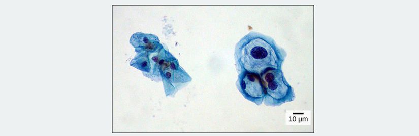 Işık mikroskobu ile görüntülenen bu rahim serviks hücreleri Pap smear testinden elde edilmiştir. Sol tarafta normal serviks hücrelerini görebilirsiniz. Sağdaki hücreler ise insan papilloma virüsü ile enfekte olmuştur.