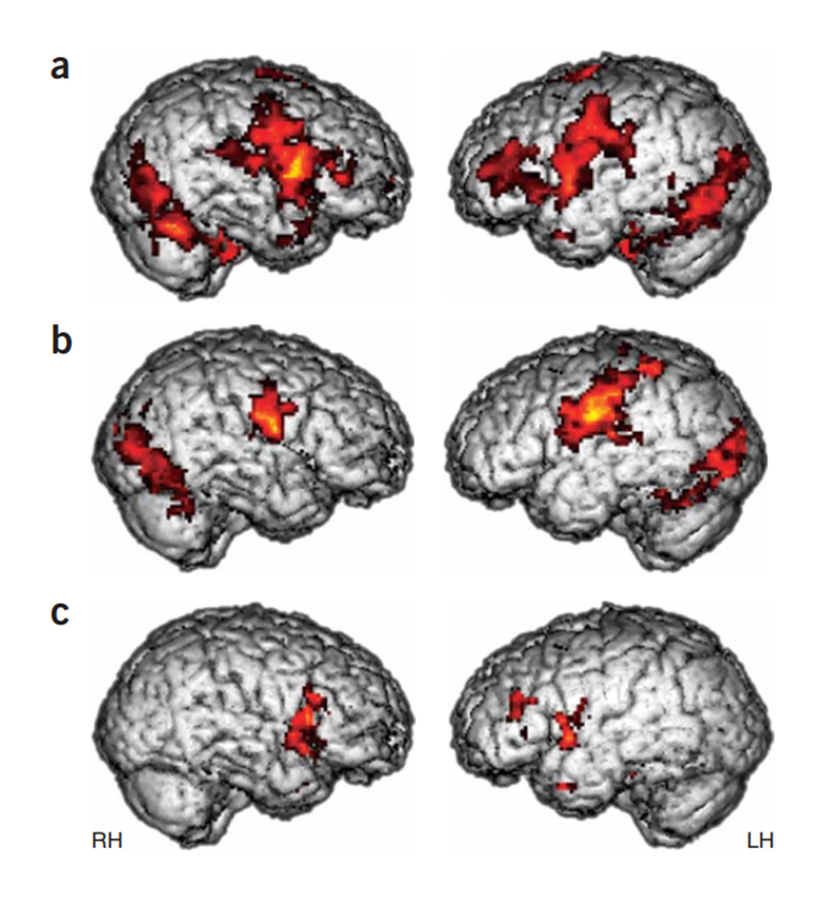 Şekil 3: Duygusal ifadelerin taklidi sırasında güvenilir aktivite. (a,b) İnferior frontal girusun bilateral pars operkülarisindeki (sağda daha güçlü) aktivite tipik gelişim gösteren grupta (a) görülürken OSB grubunda (b) görülmemektedir. Gruplar arası karşılaştırma (c) bu farkın anlamlı olduğunu ortaya koymuştur. RH, sağ hemisfer; LH, sol hemisfer.