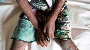 Mpox Outbreak Spreads Urgent Calls For Health Response