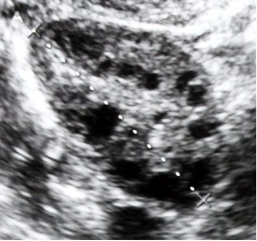 Ultrasonda polikistik overlerin görünümü (içi siyah olan yuvarlak yapıların her biri bir kist)