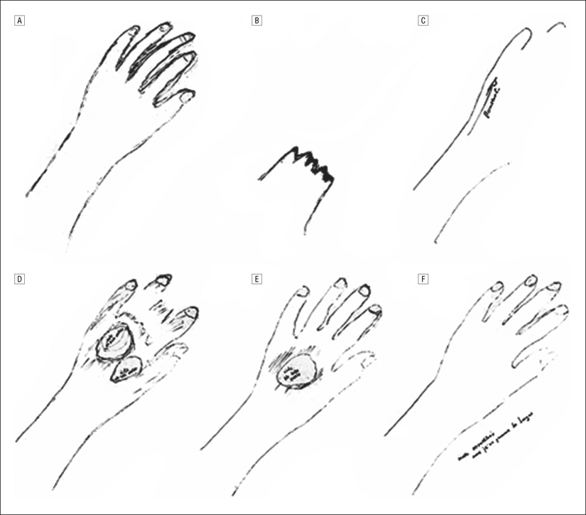 Hasta tarafından çizilen, asomatognoziyi tanımlayan resimler. A, normal sol kol; B. kaybolmuş sol kol; C, yanal olarak oluşmaya başlayan sol kol; D, sol eldeki delikler; E, 2 deliğin füzyonu; F, tam restorasyon.