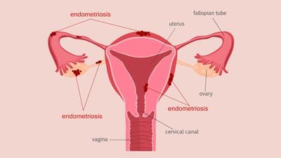 Endometriozis Nedir? Risk Faktörleri Nelerdir? Nasıl Tedavi Edilir?