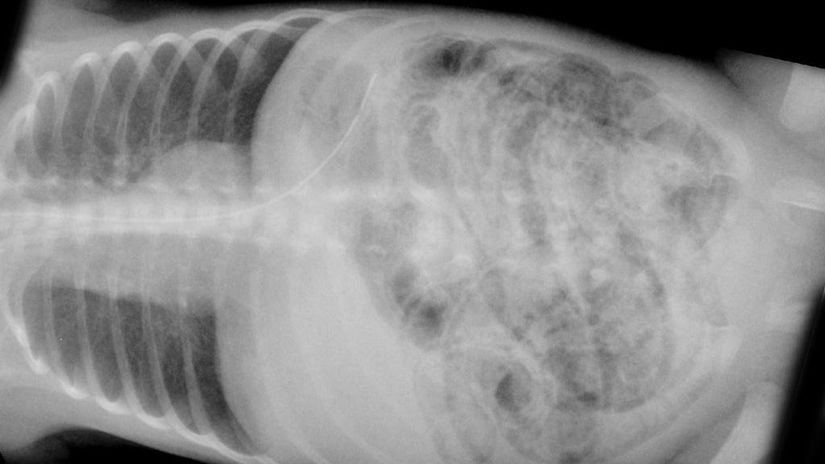 Nekrotizan enterokolit tanılı bir bebeğin radyografi görüntüsü