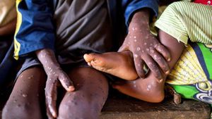 Burundi Faces Mpox Outbreak With Rising Cases And Patient Struggles