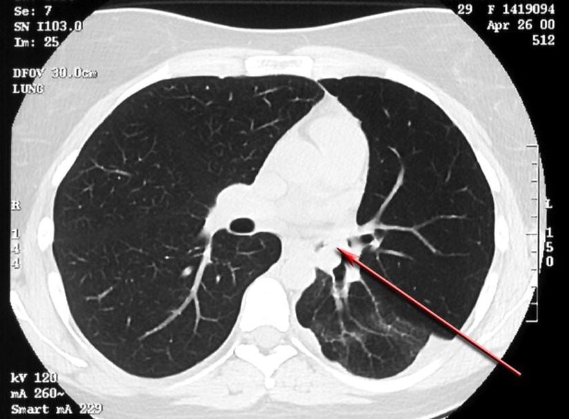 Tekrarlayan sol alt lob pnömonisi olan bir hastada inspirasyon sırasında elde edilen toraksın BT taraması bronşiyal mukoepidermoid karsinomu gösteriyor.
