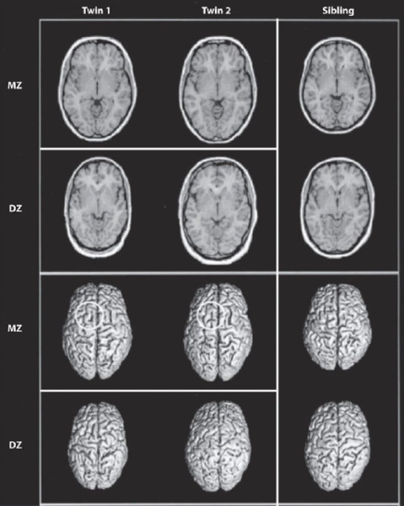 Jansen et al. tarafından oluşturulan MRI görüntüleri. MZ (tek yumurta) ikizlerin beyin yapısındaki farklılıkları tespit etmek gayet zor iken DZ (çift yumurta) ikizlerinin ve kardeşlerin arasındaki farklılıklar daha görünür.
