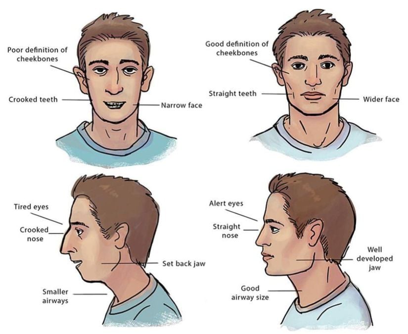 'Mouth breather' ve 'nose breather' olan iki kişinin kafatası yapısının temsili farkları