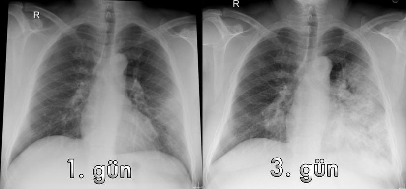 MERS hastasının akciğer (X-Ray) filmi. 1. günde sol akciğerde plevra kökenli periferal opasite mevcut. Yatışın 3. gününde sol akciğeri büyük oranda kaplayan opasite haline geldiği görülüyor.