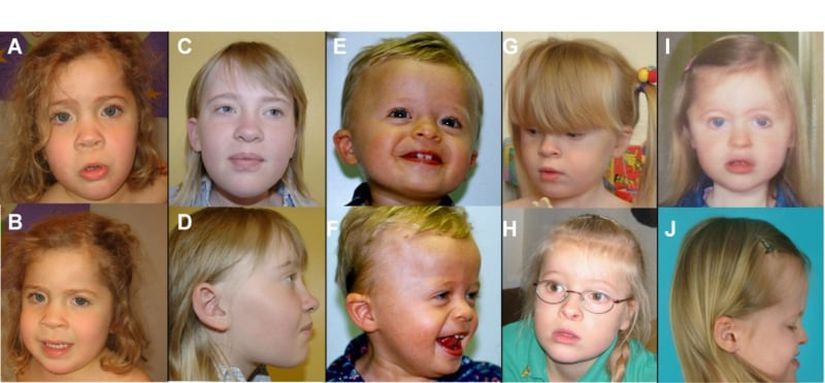 Brakisefali, geniş aralıklı gözler, sinofriz/kemerli kaşlar, orta yüz retrüzyonu, çıkıntılı dil, alt dudağın vermilyonunun dışa dönmesi ve çene prognatizminden oluşan karakteristik yüz profilini gösteren etkilenen bireylerin fotoğrafları. EHMT1 patojenik varyantları olan beş kişi (AB), (CD), (EF), (GH) ve (IJ) gösterilmiştir.