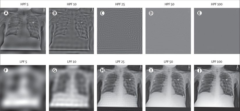 Araştırmacıların kullandığı veri setinde bulunan, kasten bozulmuş röntgenler.