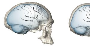 Growing Brain Sizes Offer Hopes For Alzheimer’s Prevention