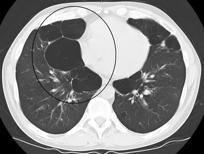 Son dönem büllöz amfizemi olan bir kişinin akciğerinin aksiyel BT görüntüsü
