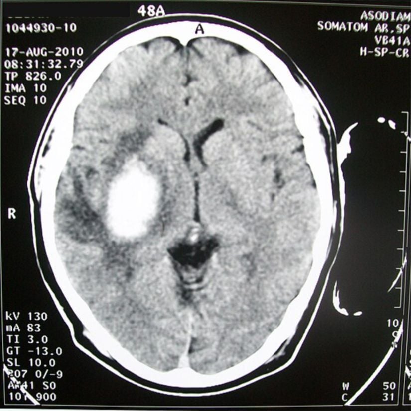 Beyin tomografisinde gözüken bir beyin kanaması