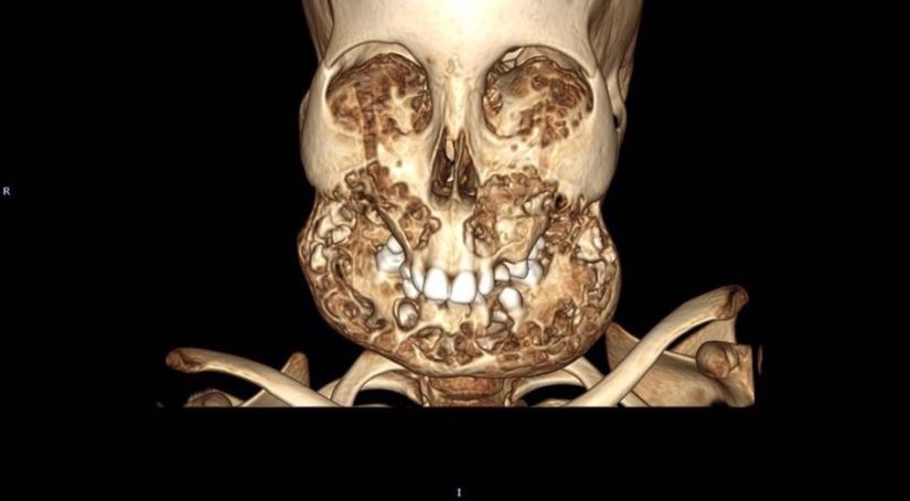 Bir Cherubism hastasının 3 Boyutlu olarak yapılandırılmış tomografi görüntüsü