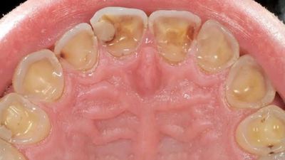 Dişler Kalbin Aynasıdır: Diş Çürüğü, Ölüme Sebep Olabilir mi?