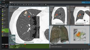 AI Innovations Are Shaping Future Of Lung Cancer Detection