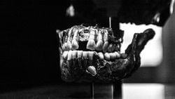 Yolunu Kaybetmiş Dişler: Dişler Yalnızca Ağızda Oluşmuyor!