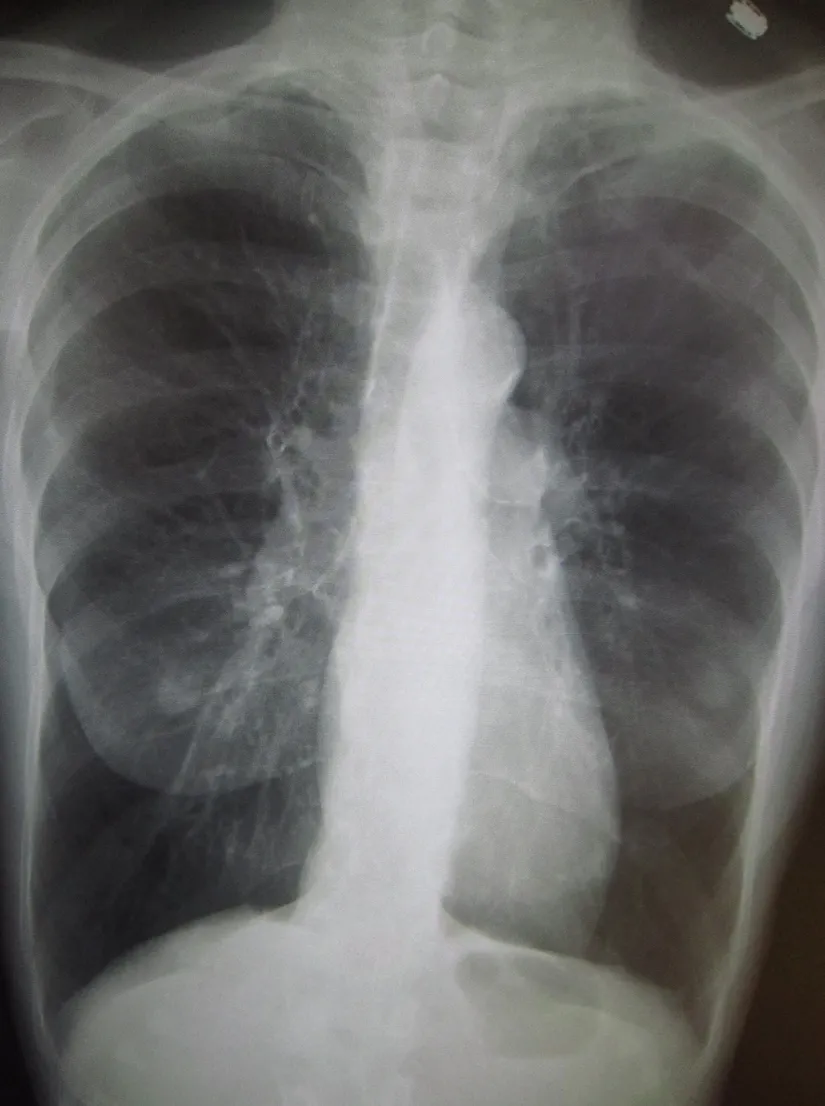 Şiddetli KOAH'ı gösteren bir göğüs röntgeni. Akciğerlere kıyasla kalbin küçük boyutuna dikkat edin.