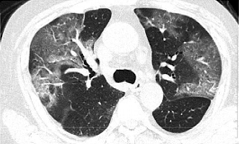 Bilgisayarlı tomografi (CT scan) yöntemi ile göğüs taraması yapılarak virüslerin etkilerine bakılıp, hastalık kolaylıkla tespit edilebiliyor.