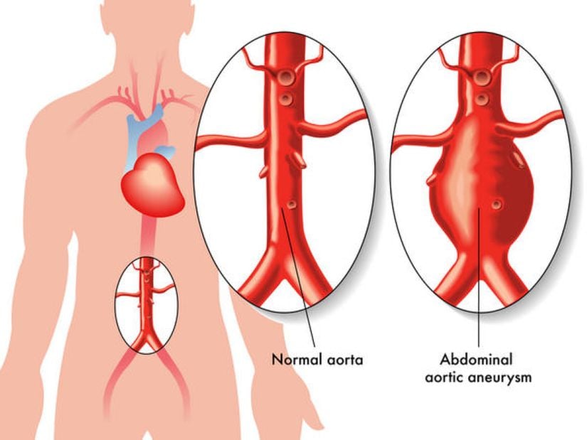 Normal Aort ve Abdominal Aort Anevrizma Karşılaştırması