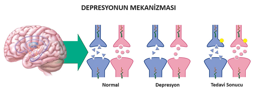 Serotoninin depresyon tedavisindeki yeri. Görselde &quot;Normal&quot; başlığının üstünde görünen kısımda iki hücre arasında normal miktardaki serotonin bulunuyor. &quot;Depresyon&quot; başlığının üstünde bulunan kısımda bir depresyon hastasının sinir hücreleri arasındaki serotonin miktarı gösterilmiş, göründüğü üzere normal bir kişiye göre daha az serotonin var. &quot;Tedavi Sonucu&quot; başlığı üstünde ise serotonin seviyesi düşük bir hastanın tedavi edilmesinden sonra iki hücre arasındaki serotonin seviyesinin &quot;normale döndüğü&quot; görünüyor.