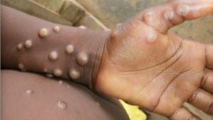 Congo Struggles To Contain Mpox Outbreak As Vaccines Arrive