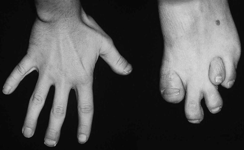 Refsum hastalığı olan birinin el ve ayak kemikleri