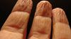 Buruşma Refleksi: Suda Kalan Parmaklarımızın Kırışma Nedeni Nedir?