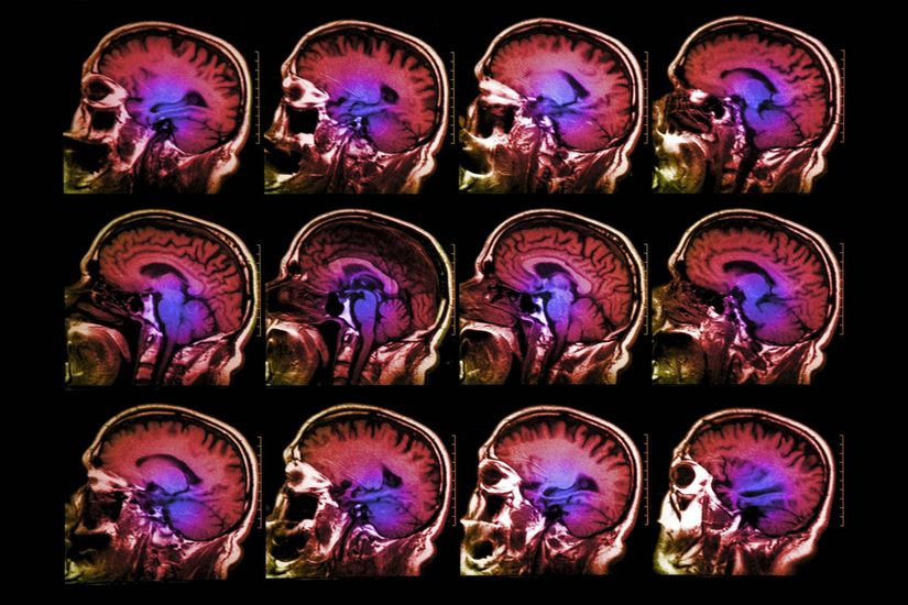 Fonksiyonel manyetik rezonans görüntüleme (fMRG), nöral aktiviteyi değil, aktif beyin alanlarını sadece kanın oksijenlenme seviyesiyle belirlediği için yeterli bulunmuyordu. Bu yöntemi, beynin 450 bölgesinde, elektriksel ve manyetik dalgalanmaları kaydeden EEG ve MEG gibi yöntemlerle karşılaştıran, yaklaşık 100.000 bağımsız veri noktasını ve beynin 450 farklı alanını ölçen araştırmacılar, fMRG ile yapılan görüntülemelerin aslında nöral aktiviteleri ve bu aktivitelerin nasıl gerçekleştiğini oldukça gerçekçi bir şekilde yansıttığını gösterdiler. fMRG, sinirbilim araştırmaları için daha fazla güvenilirlik kazandı.