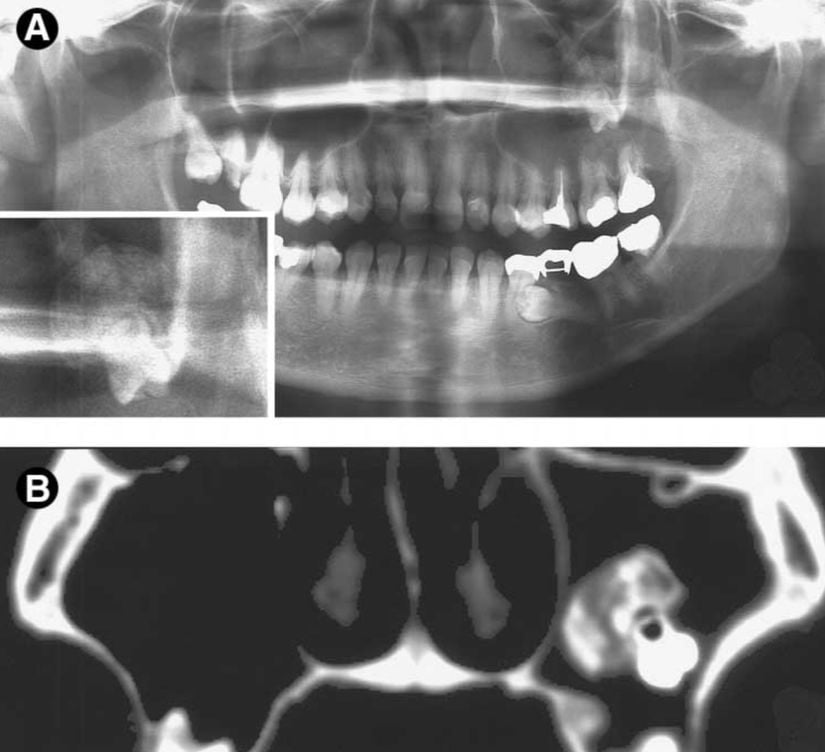 Maxiller sinüs duvarında bir osteom ve eşlik eden diş