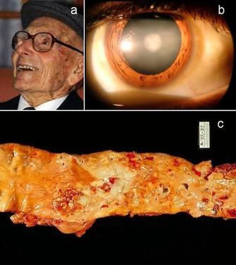Görsel 1: a) 114 yaşında ölmüş (15 Aralık 1889 – 5 Mart 2004) İspanyol, yüz on yaşın üzerinde bir asırlık çınar olan Joan Riudavets Moll’ün bir fotoğrafı. b) Yaşlı insanlarda yaşlanmanın bir göstergesi, göz merceğinin donuklaşması demek olan kataraktlardır. c) İnsanlarda diğer bir yaşlanma belirtisi, atardamar duvarının kalınlaşması/sertleşmesi anlamına gelen aterosklerozdur (koroner arter hastalığıdır). Burada, ağır bir aort damarı ateroskleroz vakası gösterilmektedir.