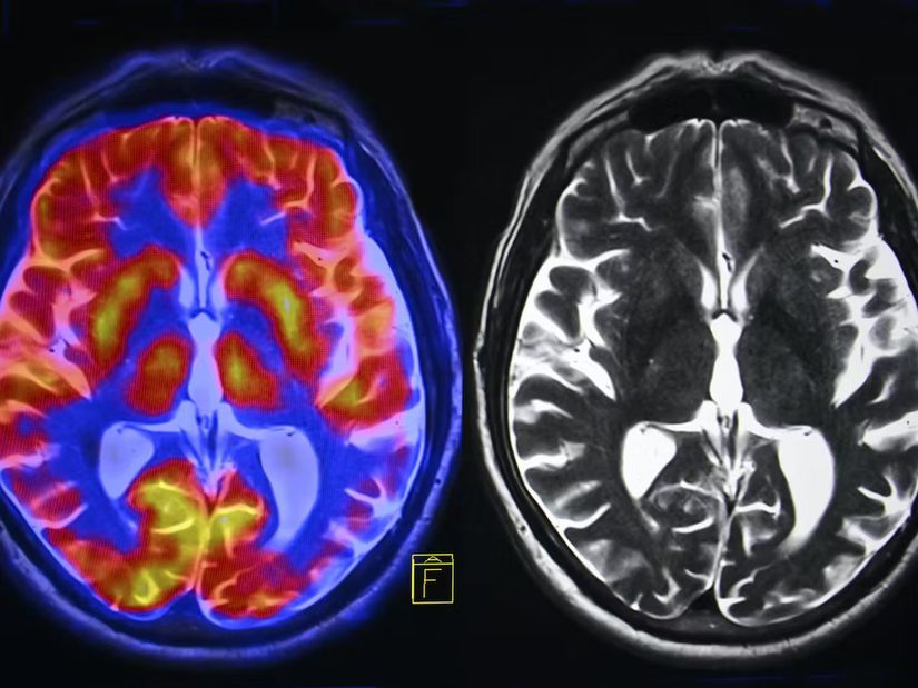 Sol tarafta sağlıklı bir insan beyni, sağda ise kronik strese maruz kalmış bir beyin yer almaktadır.