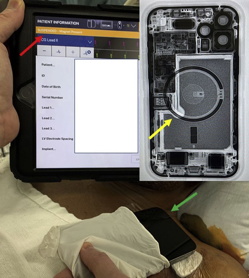 Şekilde iPhone 12'nin yaklaştırılmasıyla defibrilatörün şok etkisini askıya almasını gösteren cihaz programcısını (kırmızı ok), iPhone 12'nin içerisindeki dairesel manyetik alanı (sarı ok) ve iPhone 12'nin kendisini (yeşil ok) görmekteyiz.